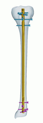 Titanium CE Anatomic Tibia Interlocking Nail
