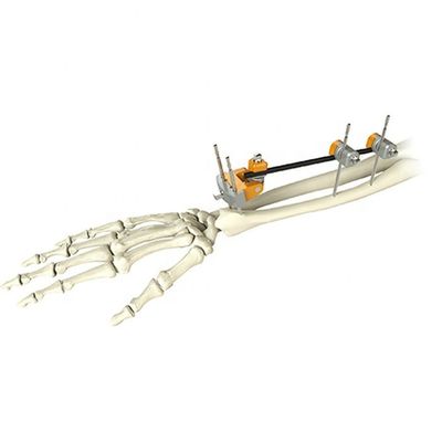 Medical Orthopedic Ulna Distal Radius Fracture External Fixation