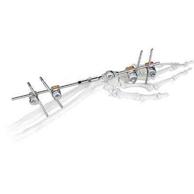 Medical Orthopedic Surgical Implant Joint Wrist External Fixator