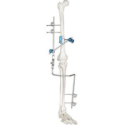 Medical Knee Joint External Fixation Device Orthopedic Surgical Instruments