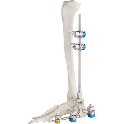 Medical Bone Hammer External Fixation Device Ankle Fracture