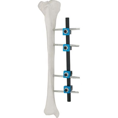 Condylar External Fixation Device