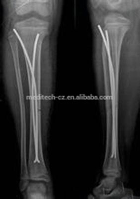 Orthopedic Implants TEN Titanium Elastic Nail For Children Surgery