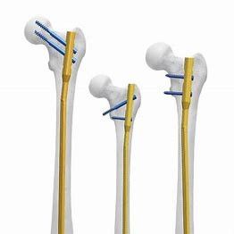 CE  11mm Intramedullary Plate Antibiotic Nail Femur