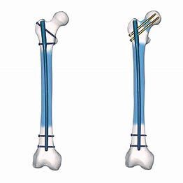 Precice Ti Alloy Surgery Interlocking Nail Femur Mechanical Stable